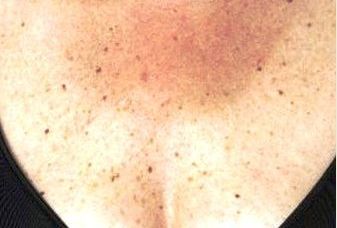 Ai observat că ai aceste pete pe piele? Iată de ce boală ai putea suferi