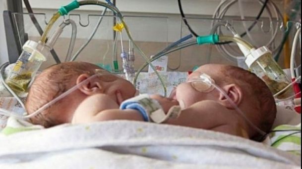 Siamezele născute acum o lună la Constanţa au murit. Fetiţele aveau o singură inimă