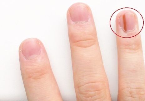 Nici nu-ți dai seama cât de grav poate fi. Mergi de urgență la doctor dacă observi asta pe unghia ta
