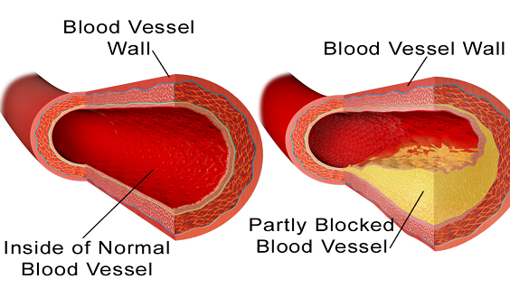 Top 10 alimente care-ți curăță arterele de grăsime la fel de bine ca medicamentele