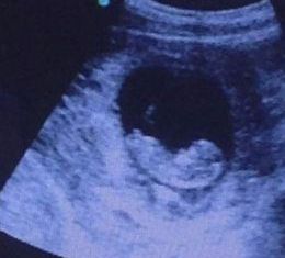 S-a uitat acasă peste imaginea ecografiei. Detaliul înfricoșător pe care l-a observat lângă bebeluș