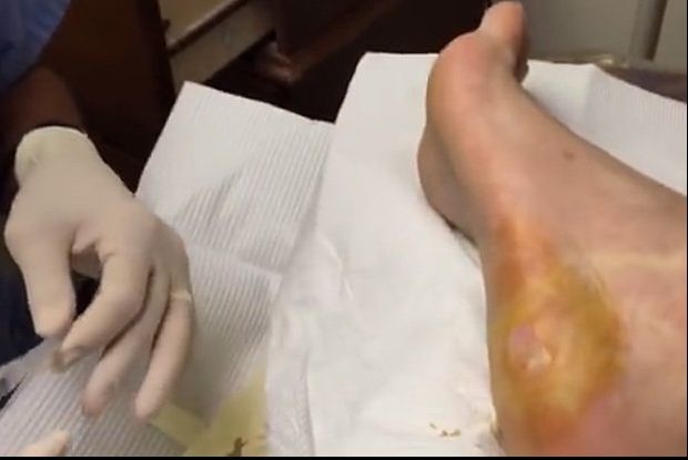 S-a dus la medic să-i trateze bătătura,dar a descoperit că...Numai cei curajoși pot urmări imaginile