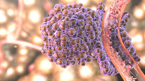 Motivul surprinzător pentru care cei mai mulţi oameni fac cancer