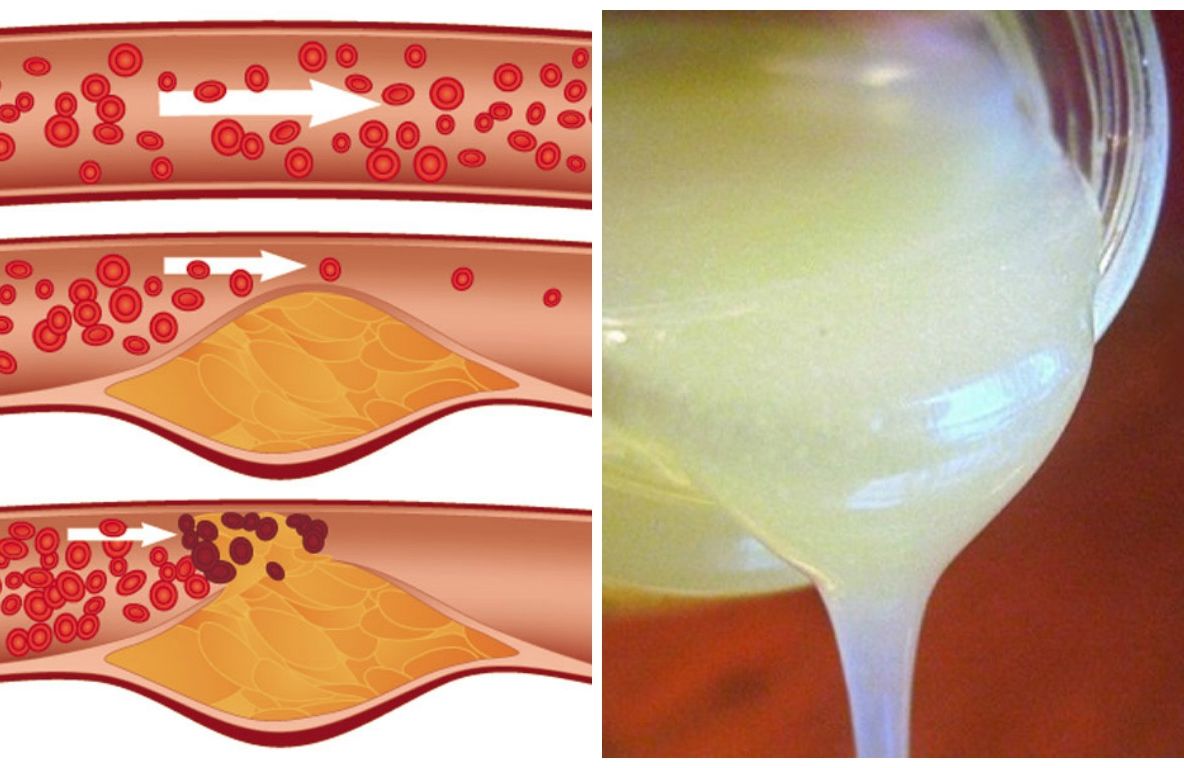 Remediu pentru desfundarea arterelor, reducerea colesterolului și întărirea imunității