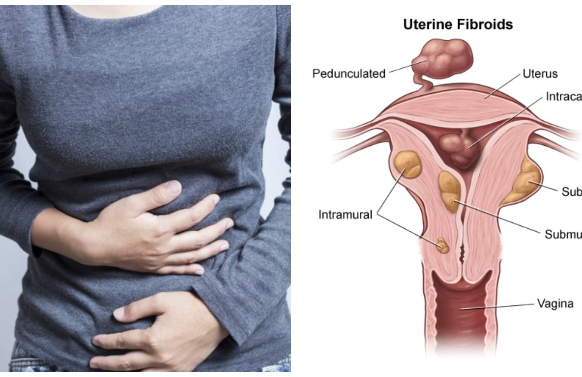 Ce boală ascunde balonarea. Tumoarea care crește încet, dar sigur