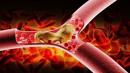 5 lucruri esenţiale pe care ar trebui să le ştii despre colesterol