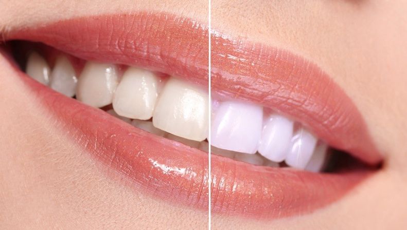 De ce se îngălbenesc dinții. Cauza la care nu te-ai fi gândit 