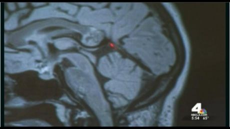 Descoperirea şocantă a chirurgului care a operat tumora pe creier a unei femei. Ce era, de fapt