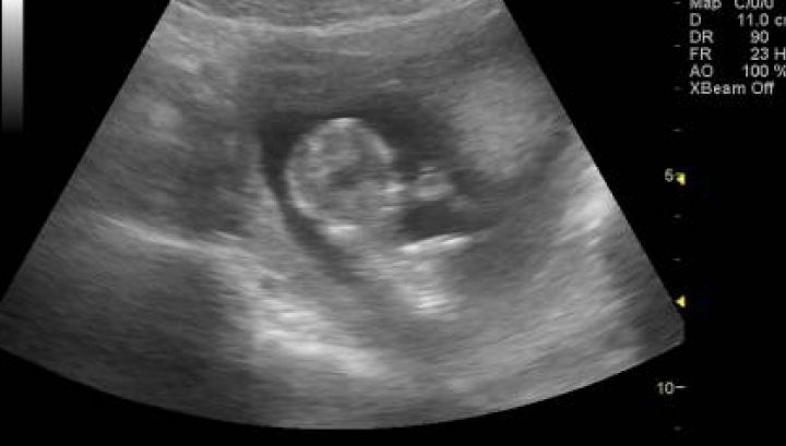 A rămas însărcinată, dar nu a făcut nicio ecografie. Când a ajuns la spital, medicii s-au îngrozit