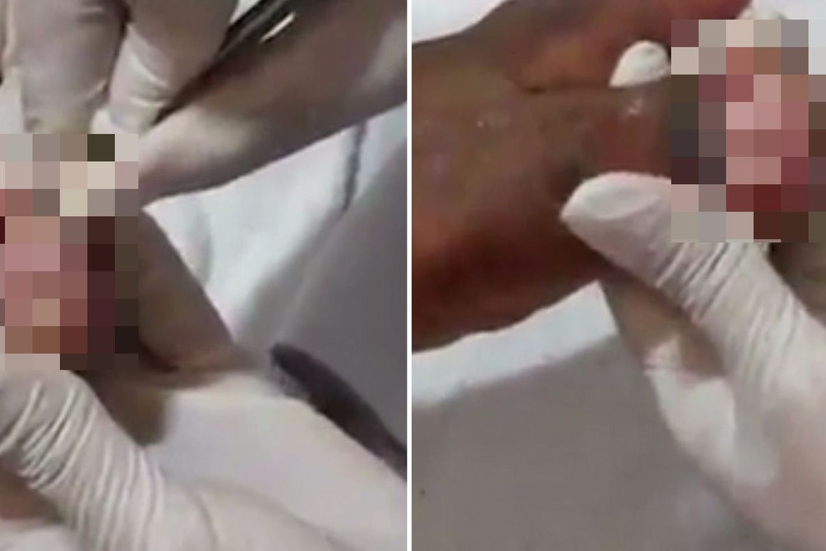 I-a crescut unghia până a intrat în piele. Medicul a tăiat excesul. A leșinat când a văzut ce scoate