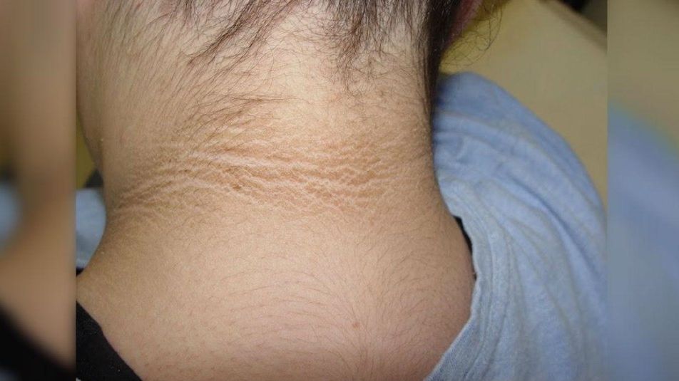 Mama a observat o pată de culoare închisă pe gâtul fiicei sale… Diagnosticul a fost un adevărat șoc!