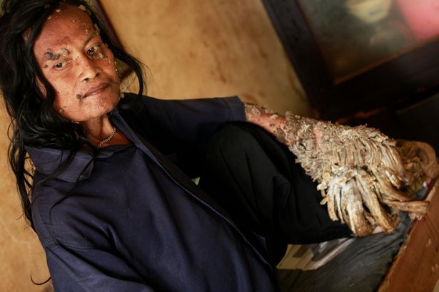 ”Omul-copac” a murit după o lungă suferință. Visa să-și găsească o iubită