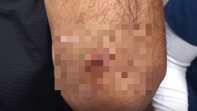 Avea o umflătură sub cot. S-a dus la medic să i-o spargă. A leșinat când a văzut ce iese din ea