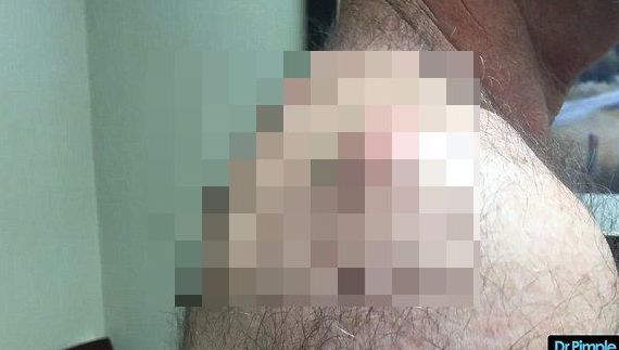 A mers la medic să-și stoarcă coșurile de pe spate.Le avea de 17 ani.Când a strâns au ieșit monștrii