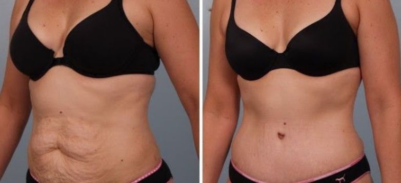 Cum să scapi de vergeturi şi de grăsimea abdominală printr-o metodă foarte simplă!