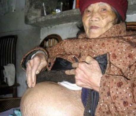 Cazul uimitor al unei femei care a purtat un copil mort în pântece timp de 60 de ani