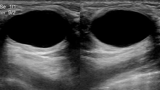 Acest amestec distruge chisturile mamare şi fibromul