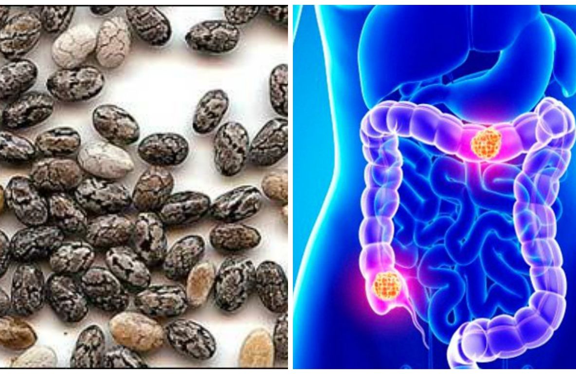 Probabil cel mai bun remediu natural pentru cancerul de colon. Din păcate, puțină lume îl știe