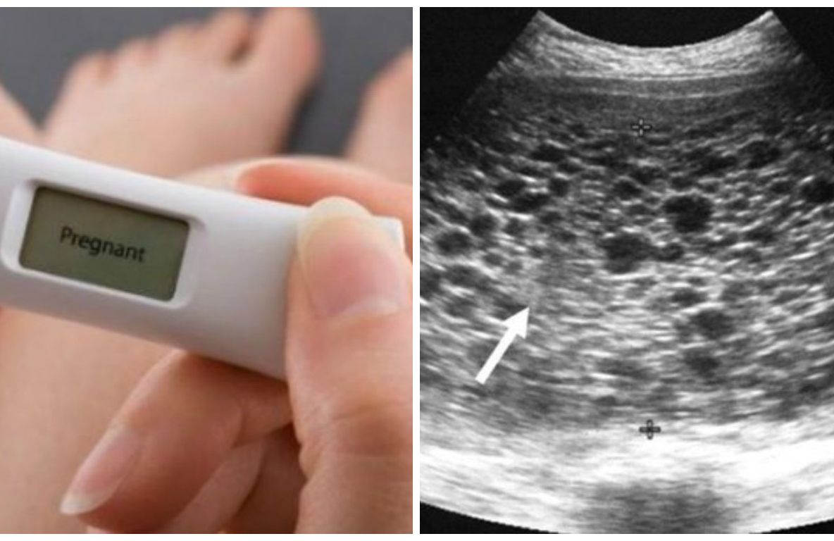 Testul a arătat că e însărcinată și era fericită. La prima ecografie, medicul s-a îngrozit