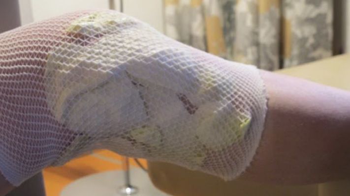 A aplicat frunze de varză, în fiecare seară, pe genunchi. Rezultatul, spectaculos!