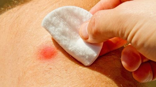 Tratamentul naturist care te scapă definitiv de furuncule