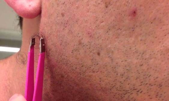 I-a crescut un fir de păr sub piele. Şi l-a scos cu penseta. Ce a ieşit de acolo e SINISTRU