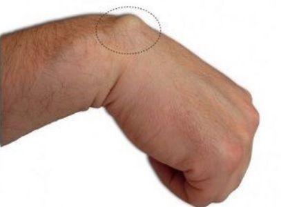 Cel mai rapid tratament naturist pentru lipoame