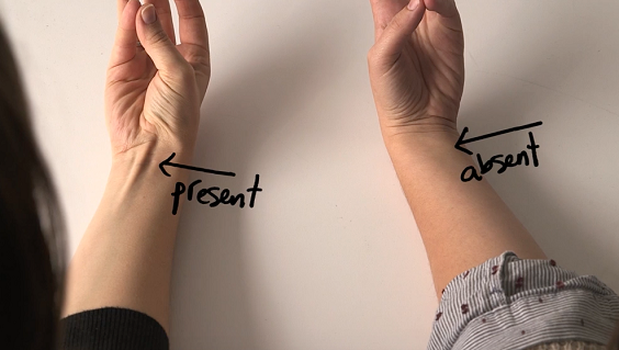 Mușchiul pe care doar unii oameni îl au. Ce se întâmplă dacă nu ești printre ei