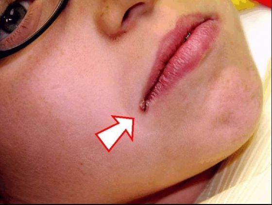 Cum scapi rapid de crăpăturile care apar în colțul gurii. Cea mai eficientă metodă