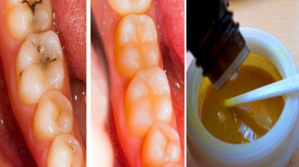 Scapă de carii în mod natural! Această soluţie uimitoare o poţi prepara în casă