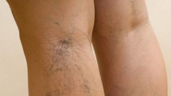 Cel mai simplu şi eficient remediu natural pentru varice. Efectele se văd imediat!