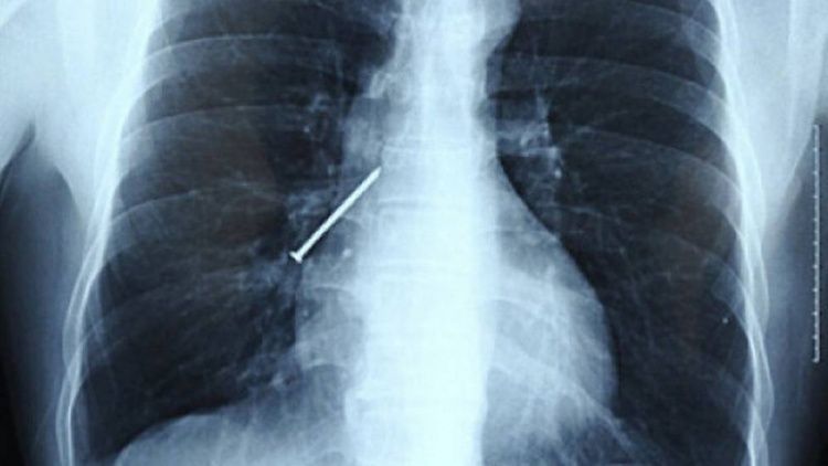 Cele mai ciudate 10 obiecte găsite în corpul uman