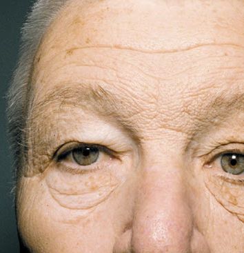 L-a bătut soarele, timp de 20 de ani, doar pe partea stângă. Apoi, a observat ceva îngrozitor