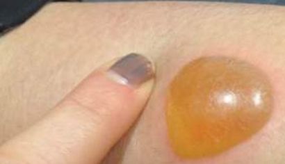 I-a apărut o băşică gălbuie pe picior, iar după ce a spart-o a ieşit...