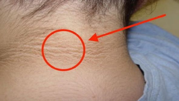 Ai un cerc întunecat pe pielea din jurul gâtului, mergi de urgenă la medic! Iată ce înseamnă