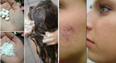 Remediul ieftin pe care şi tu îl ai în casă: tratează acneea şi te scapă de mătreaţă