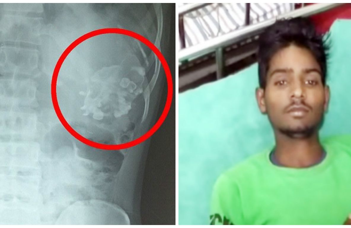 A ajuns la spital cu dureri abdominale crunte. ȘOC: în stomac, doctorii l-au găsit pe fratele lui