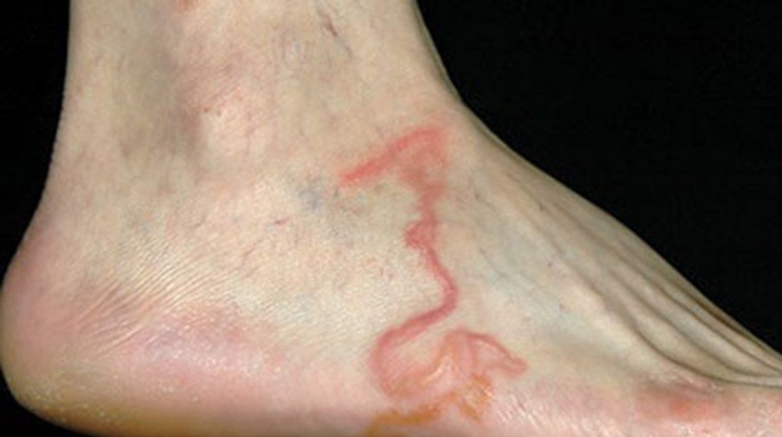 Credea că i s-a umflat o venă la picior. A rămas şocat să afle ce avea de fapt 