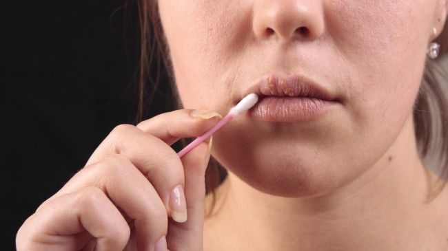 Cum să scapi de herpes simplu şi rapid. Acesta este cel mai eficient tratament