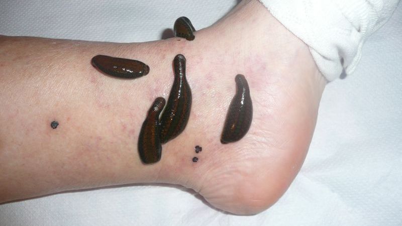 A pus lipitori pe picior pentru a trata varicele. Ceva cumplit s-a întâmplat. Medicii s-au îngrozit