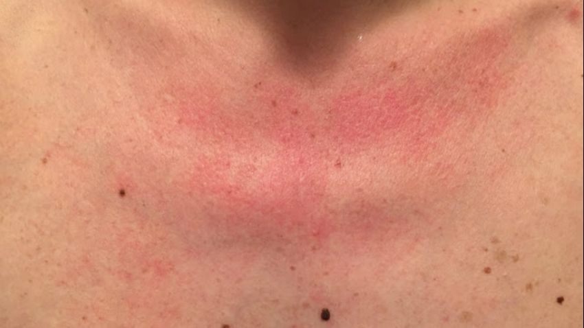 De ce îţi apar pete roşii pe piept după ce faci duş