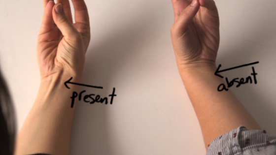 Cu braţul întins, uneşte-ţi degetul mare cu cel mic. Ce înseamnă dacă apare o proeminenţă