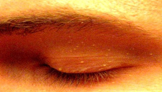 Ai aceste semne pe piele? De ce boală poți suferi