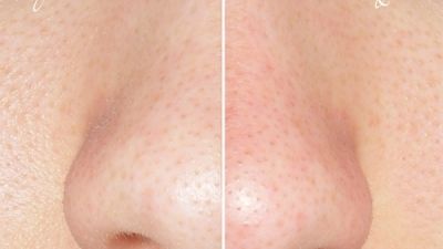 Două ingrediente amestecate te vor scăpa de punctele negre şi riduri 