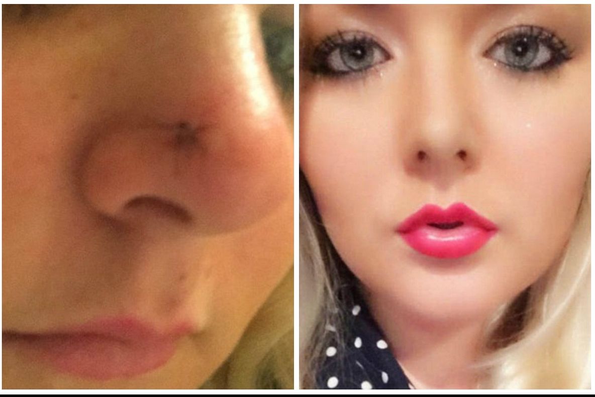 A observat că i-a apărut pe nas o aluniță. Era fericită! Medicul i-a dat însă o veste tulburătoare