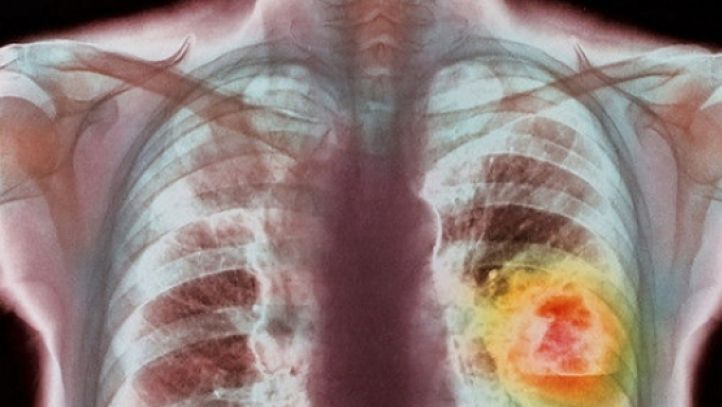 Ai aceste simptome? Ar putea fi cancer pulmonar  