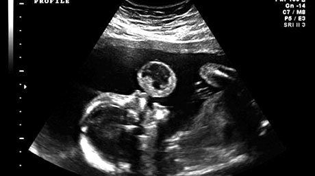 A râs, la ecografie, când a văzut că fătul ei scoate baloane. Dar medicii i-au dat o veste cumplită