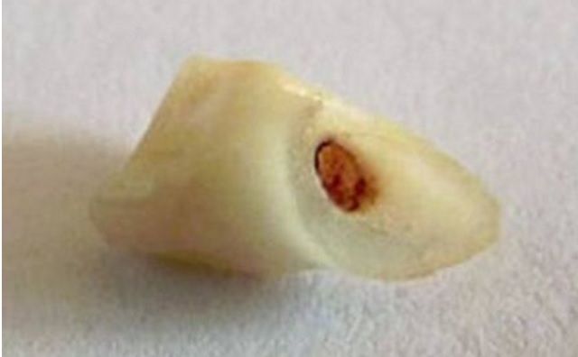 A pus un dinte într-un pahar de Cola. După 40 de zile l-a scos. E șocant ce s-a întâmplat!