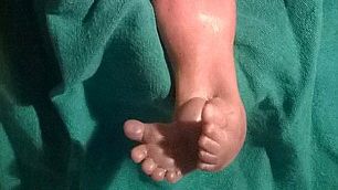 Imagini greu de privit! Bebeluşul-sirenă, născut în India, care a bulversat lumea medicală