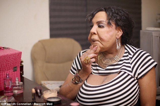 A visat să devină femeie și și-a injectat ciment în pomeți. S-a desfigurat! Transformarea e hidoasă